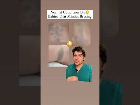 A Normal Condition