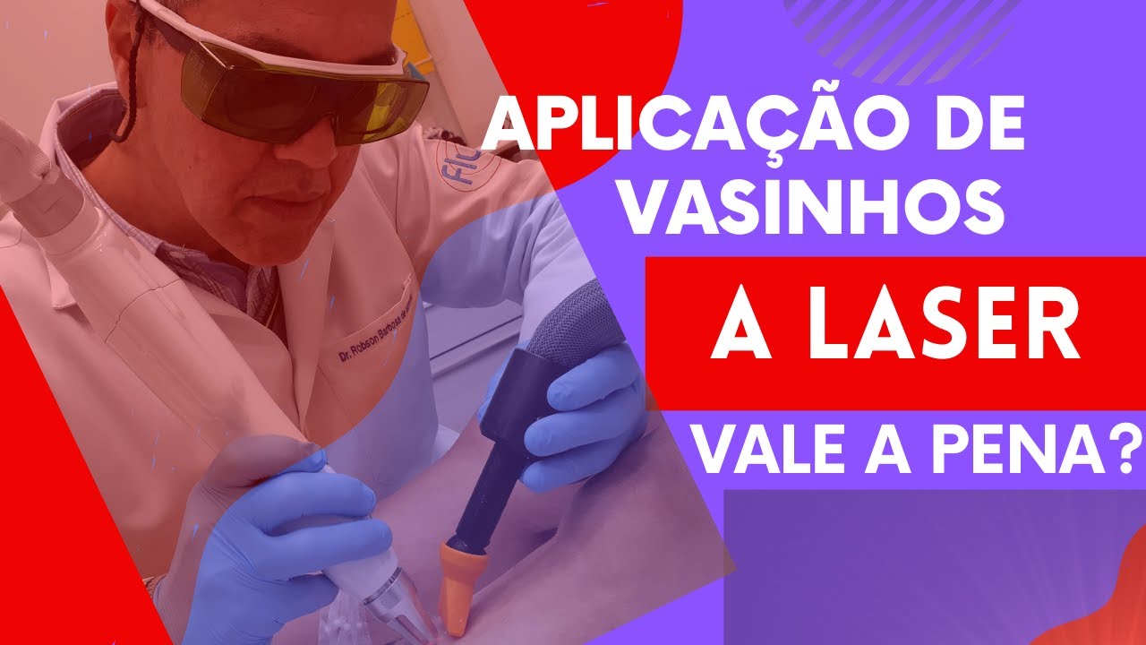 Aplicação de vasinhos a Laser, Aplicação de vasinhos com Espuma e ...