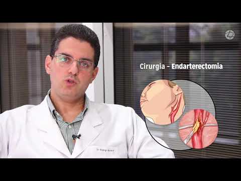 Vídeo: Aterosclerose Cerebral Dos Vasos Cerebrais - Tratamento