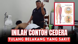 MCO ARIF - INILAH CONTOH (SARAF KEJEPIT) TULANG BELAKANG YANG SAKIT SEKALI