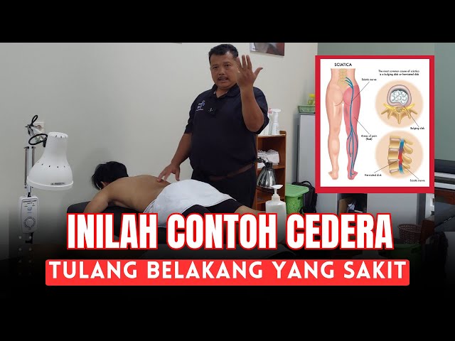 MCO ARIF - INILAH CONTOH (SARAF KEJEPIT) TULANG BELAKANG YANG SAKIT SEKALI class=