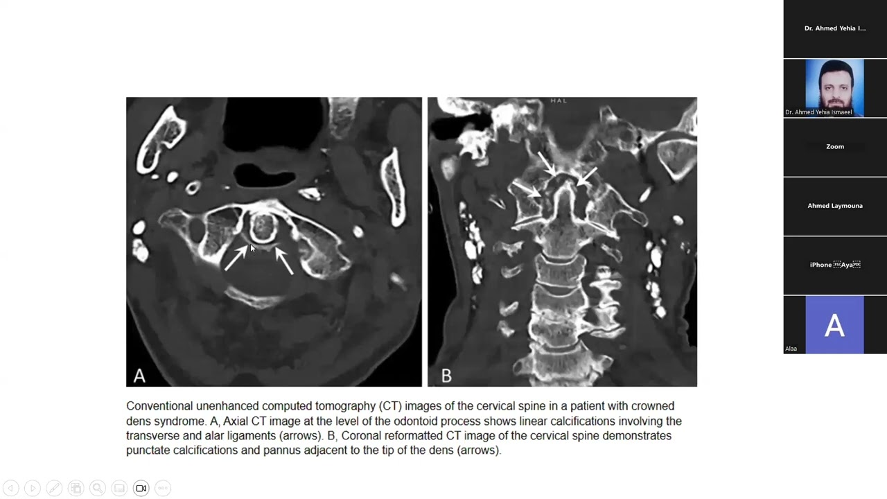 CPPD Calcium Pyrophosphate Deposition part 2 Dr. Ahmed Hatem Laymona, MD & Lecturer Cairo University