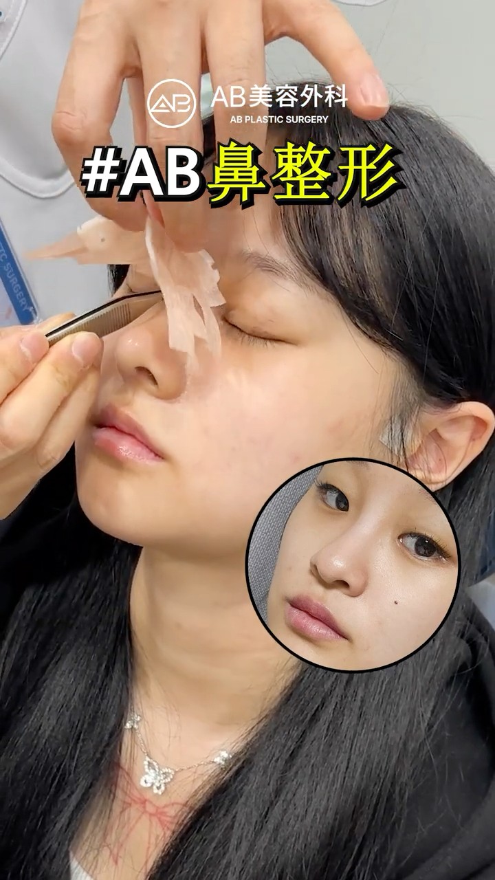 허은결 鼻整形のギプス外し…衝撃のビフォーアフター #shorts