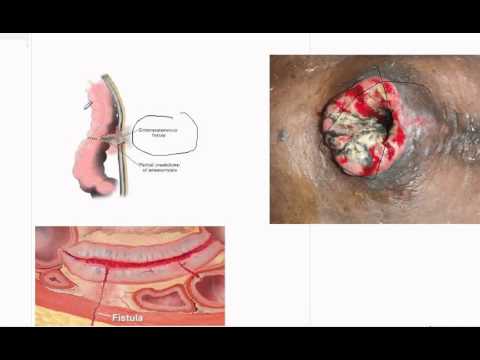 Video: Fistula - Jenis, Penyebab, Gejala Dan Rawatan Fistula