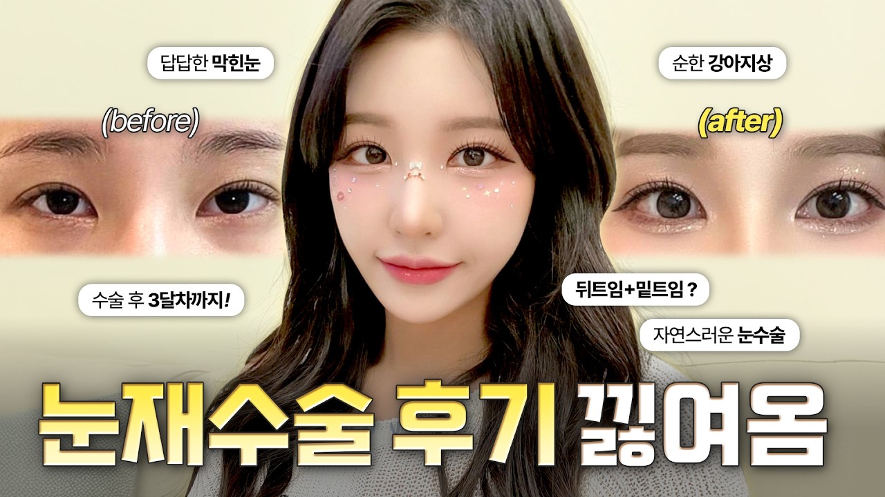 답답한 막힌 눈 탈출! 눈재수술 + 뒤밑트임으로 순한 강아지상🤫✨