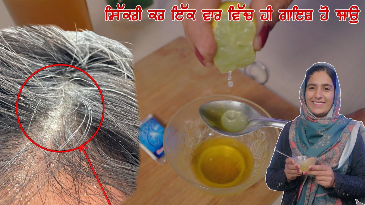 ਸਿੱਕਰੀ ਇੱਕ ਵਾਰ ਵਿੱਚ ਹੀ ਗਾਇਬ ਹੋ ਜਾਉ | Home Treatment for Dandruff