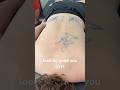 Shoulder Blade Pain? Fix it with Dry Needling