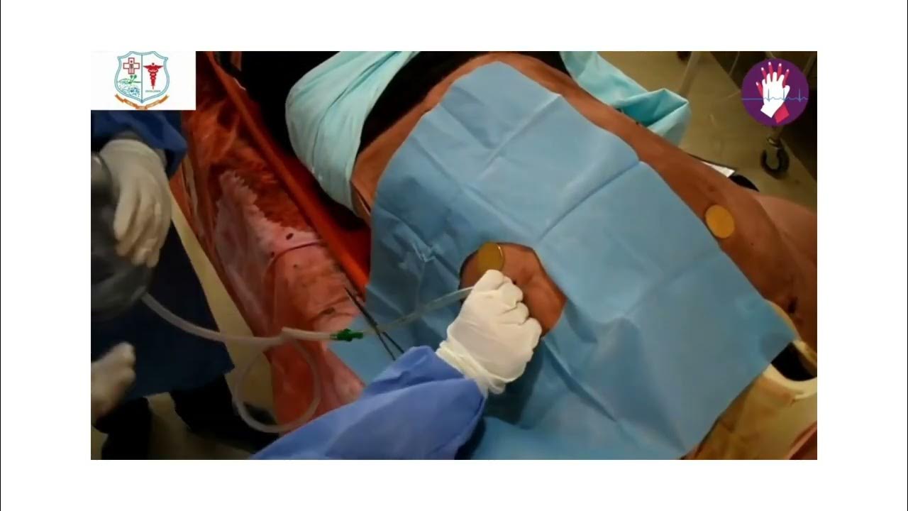 ICD insertion YouTube