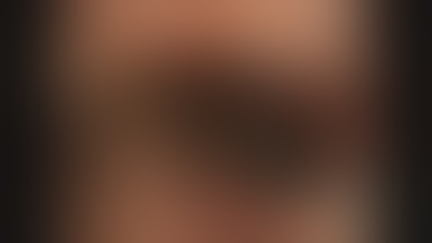 ERCP Stone Extraction #BD_ENDOSCOPY