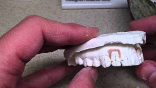 Clear Aligner - Invisible Orthodontic Retainer to Move Teeth