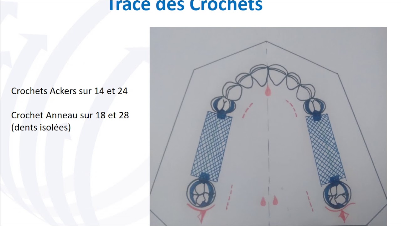 Traces Types : CI III - CI I Maxillaires