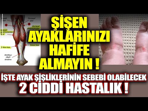 Ayaklarınız Şişiyorsa Asıl Nedeni 2 Hastalıktan Biri Olabilir !