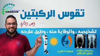 تشخيص تقوس الساقين [ الركبتين ] وكيفية الوقاية منه وعلاجه | ج2 | سلسلة ضعف العظام | ح31 - الأخيرة