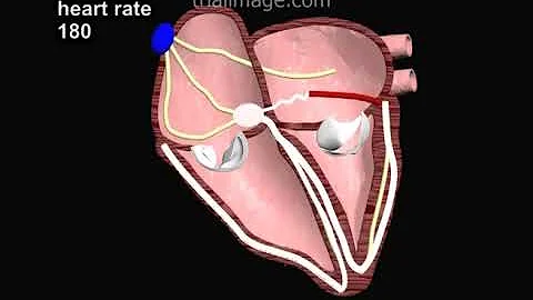 Wolff Parkinson White Syndrome Animation by Cal Shipley, M.D.
