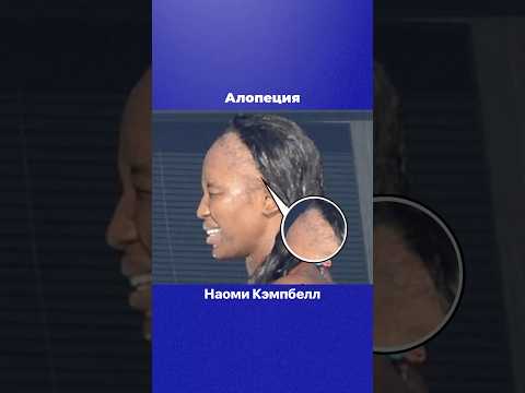 Алопеция Наоми Кэмпбелл #naomicampbell #naomi #внешность #алопеция
