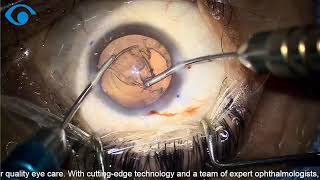 From Blur to Clear — Cataract Surgery 🔴LIVE | Toric II 1-Piece IOL #eyesurgery #cataract #drishti