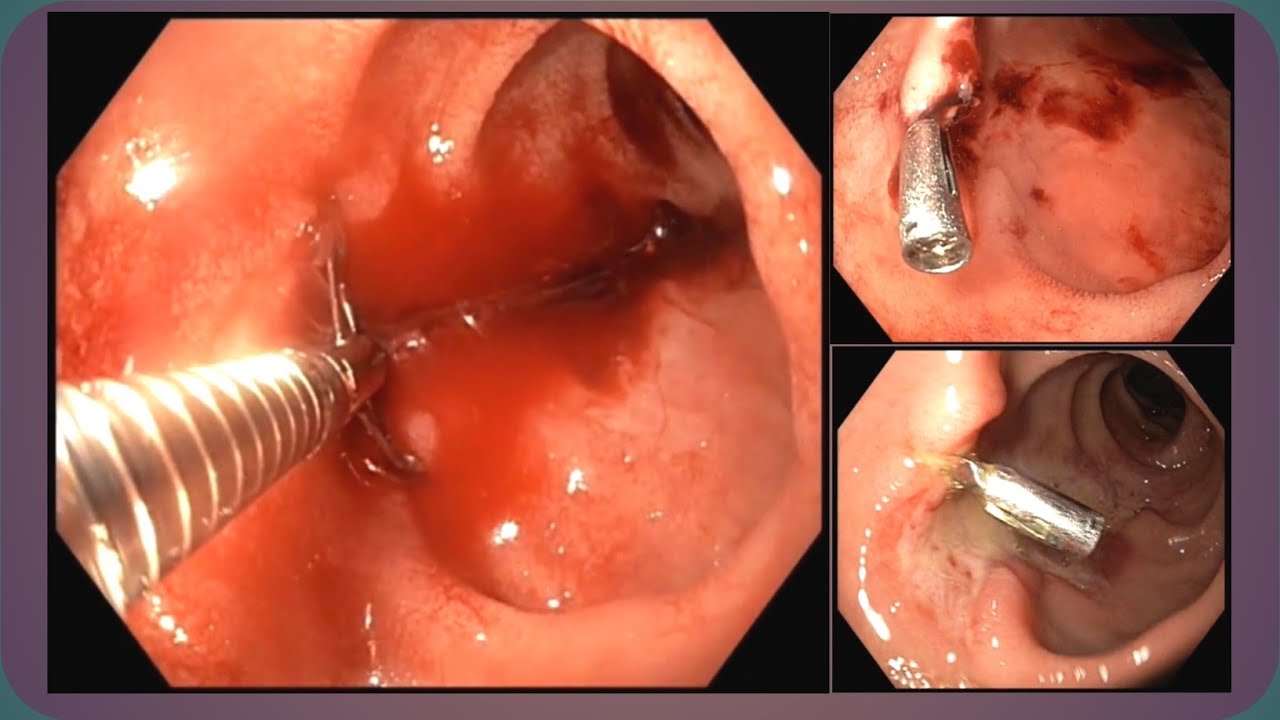 Clip Hemostasis II Hemo Clip Application II হেমোস্থেসিস ক্লিপ লাগানো 