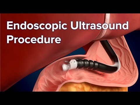 Endoscopic Ultrasound (EUS) Procedure | Cincinnati