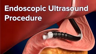 Endoscopic Ultrasound (EUS) Procedure | Cincinnati Children's