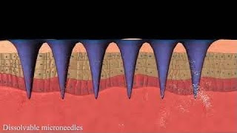 Dissolvable microneedles 