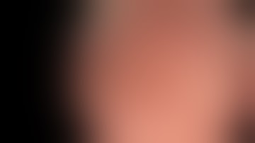 Underwater EMR of Cecal Polyp