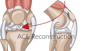 Why does it take so long to recover from an ACL injury?