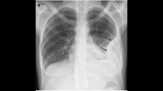Full Pleural effusion diagnosis, workup and management.(Harrison's guidelines included). Update