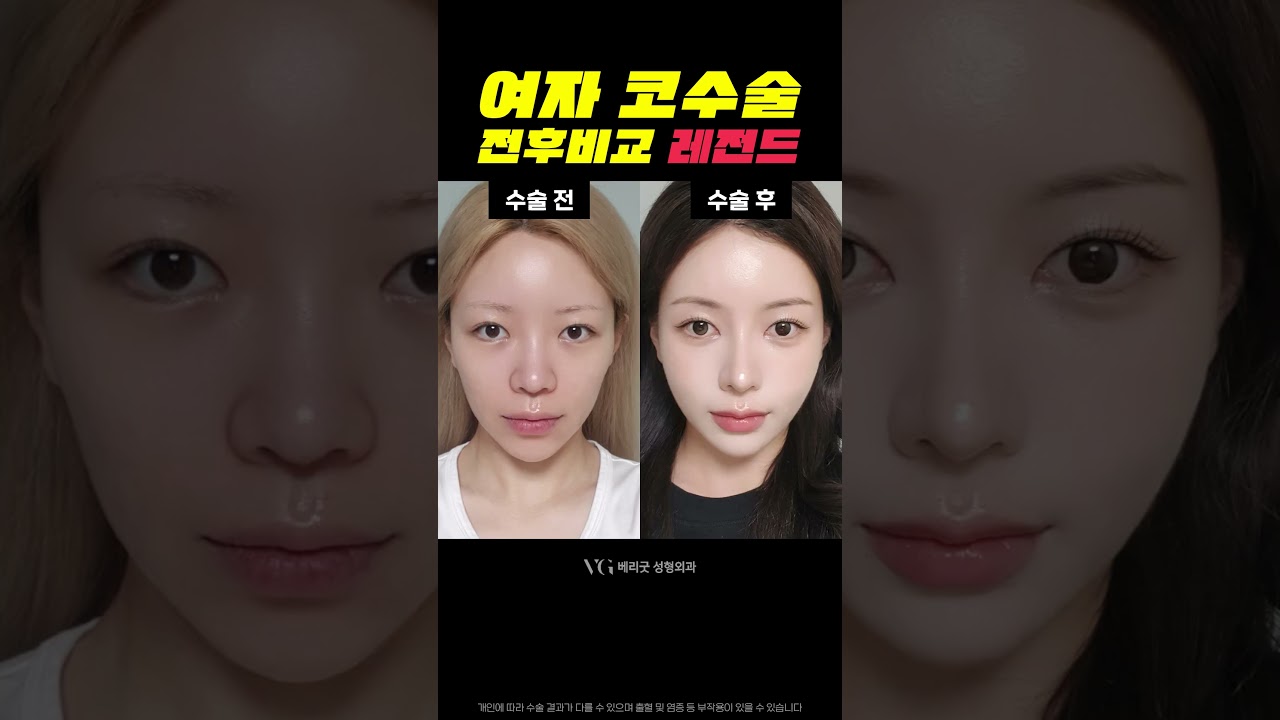 [薇麗好整形外科診所] 隆鼻後，從「土氣女」變身「氣質女」的氛圍大轉變故事