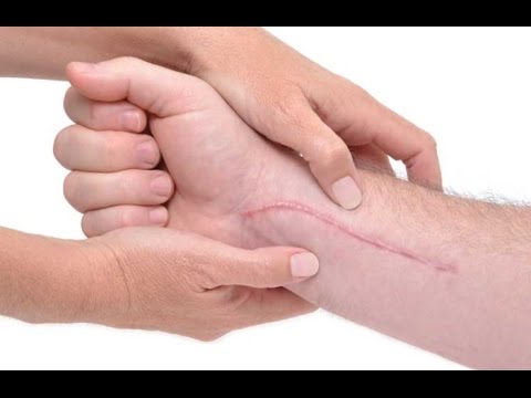 medicament pour enlever cicatrices medicament pour enlever cicatrices
