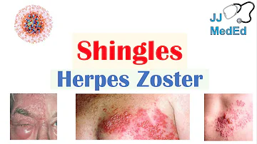 ¿Cuándo se considera que el herpes zóster es una urgencia?
