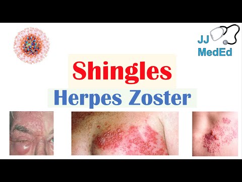 Shingles (Herpes Zoster): Pathophysiology, Risk Factors, Phases of Infection, Symptoms, Treatment