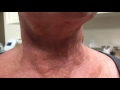Results from Plasma Minimally Invasive Neck Lift at 6 days after procedure!