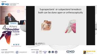 Biomechanical comparison of arthroscopic subpectoral biceps tenodesis technique   Vladimir Senekovič