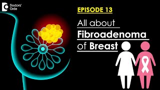 What Are Fibroadenomas? Are They Precancerous? Treatment Options-Dr.Sreekanth Reddy| Doctors' Circle