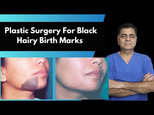 चेहरे के काले बर्थमार्क्स की प्लास्टिक सर्जरी || Dr. S. K. Gulati