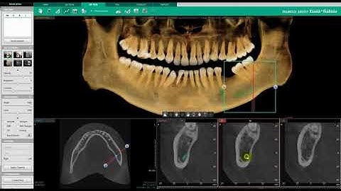 Ez3D-i | 3D PAN Tab | Drawing a Mandibular Nerve