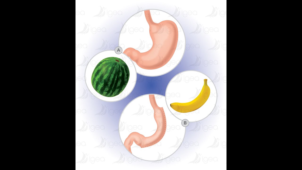 SLEEVE GASTRECTOMIE MONTPELLIER