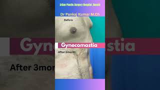 Scarless Gynecomastia surgery in Ranchi| best treatment of Gynecomastia #gyno