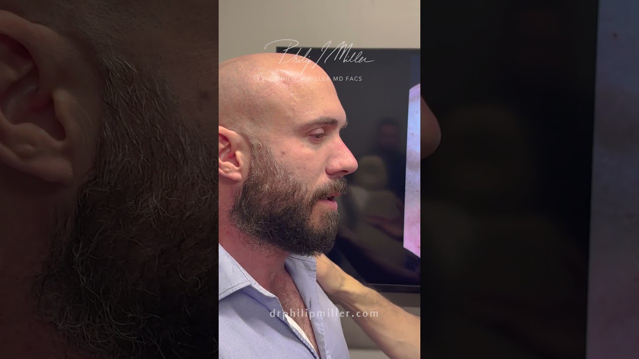 Preservation Rhinoplasty! 8 Months Post-op