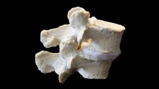 Degenerative spondylolisthesis anatomical spine model