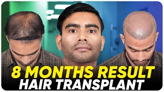 Hair Transplant in Bangladesh | Best Results & Cost of Hair Transplant in Bangladesh