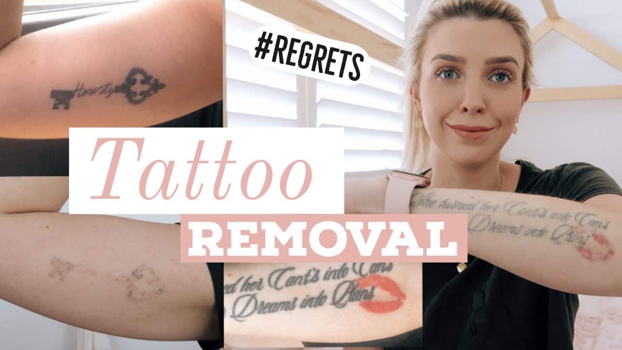 How Much Does Laser Tattoo Removal Cost In Sydney?