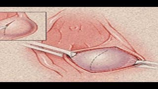 تشخيص كيسة بارثولين فى الفرج د.محمدجاد  Bartholin’s cyst 2 #الصحة_الجنسية