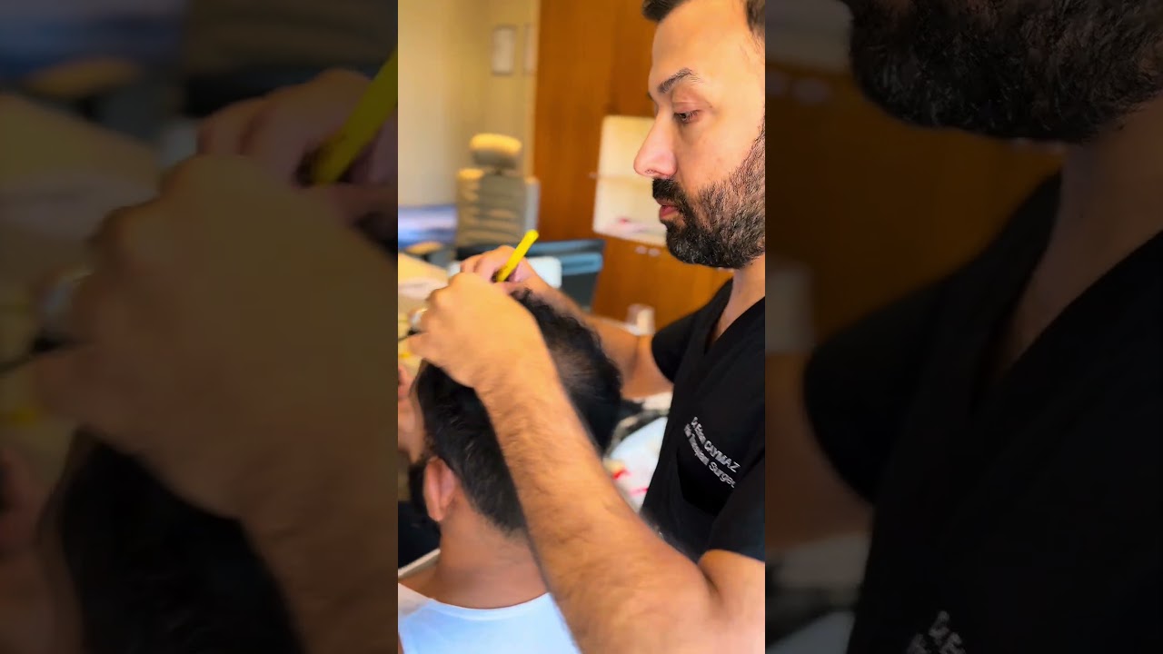 Best Hair Transplant #hairtransplant