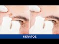 Keratoz  dri lksi  quba rstmova dermatoveneroloq  kosmetoloq 