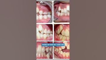 Các trường hợp nên niềng răng dù không muốn #nhakhoahanoisydney #niengrang #trend #invisalign #typ