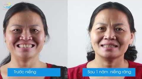 NGOÀI 30 TUỔI CÓ NIỀNG RĂNG ĐƯỢC KHÔNG? nha khoa Lạc Việt