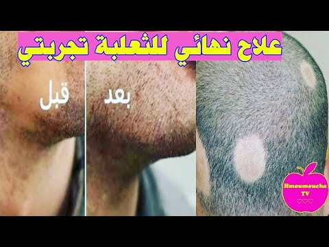 علاج الثعلبة بثلاث أيام