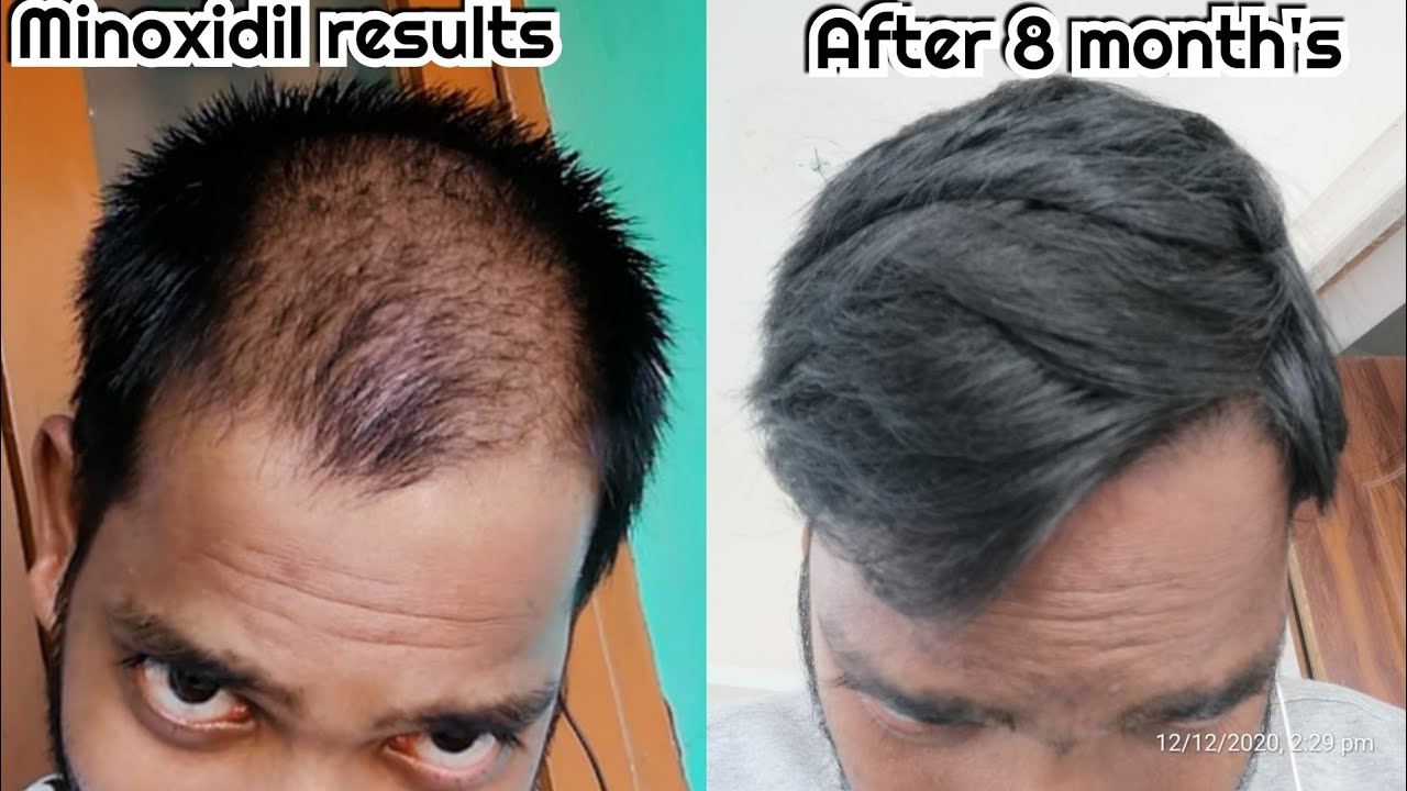Minoxidil & Finasteride results after 8 months of use : case study - YouTube