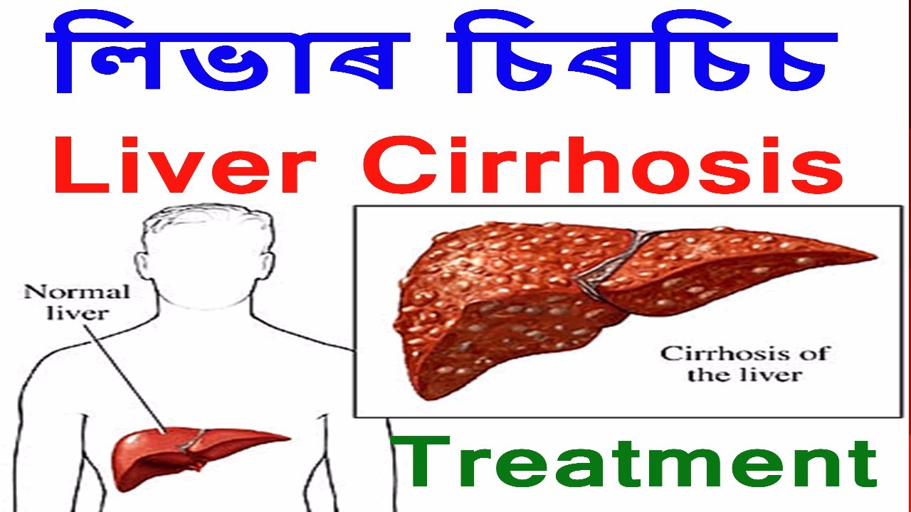 লিভাৰ চিৰচিচ কিয় হয়? || what is the treatment for cirrhosis? Drhariswellfuture